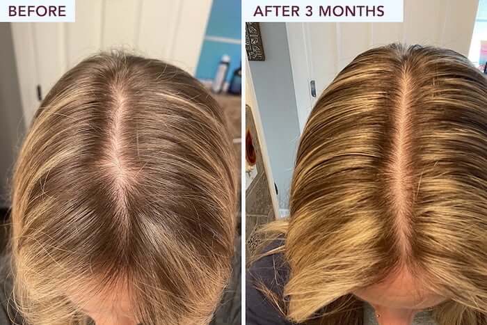 FullyVital Hair Growth Serum Before After